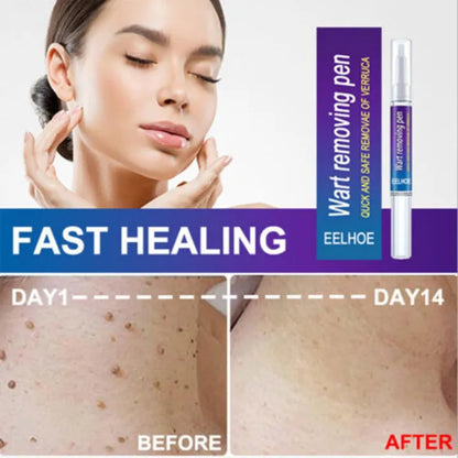 Wart Removing Gel, Remove Wart - Tag Mole Remover