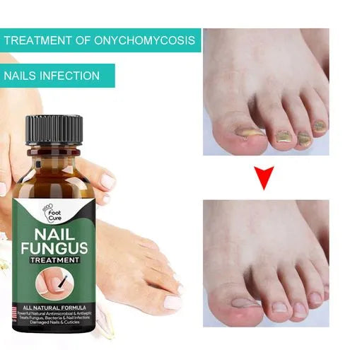 Nail Fungal Repair Serum | Nail Fungus Removal Gel